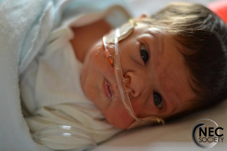 Micah Necrotizing Enterocolitis